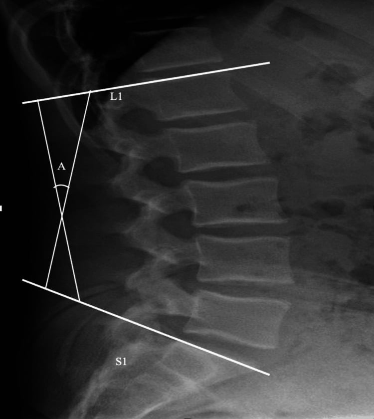 Lateral radiograph with lumbar lordosis measured between the L1 superior endplate and the S1 endplate