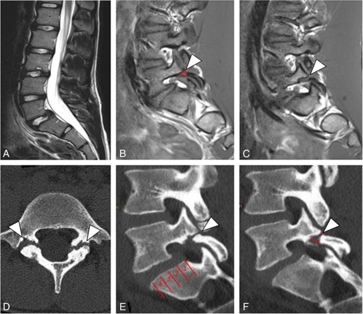 Sagittal T2 and T1 MRI with matching CT showing Meyerding grade I anterolisthesis at L5-S1 with a six millimetre slip and the pars defects