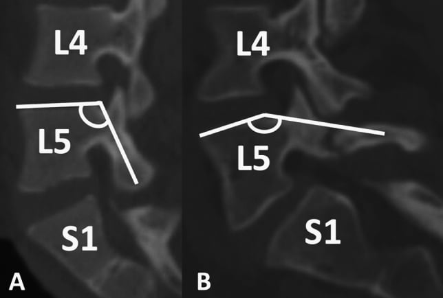 Comparison of a shallow horizontal pars interarticularis angle in a patient without spondylolysis and a flat pars angle in a patient with spondylolysis