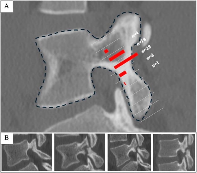 CT showing the location of the pars fracture along the pars interarticularis with examples of the variability in fracture position between patients