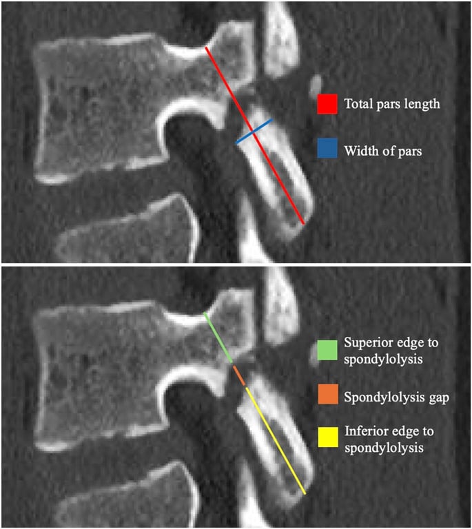 CT with total pars length and pars width measured, and separate measurements from the superior and inferior edges to the spondylolysis gap