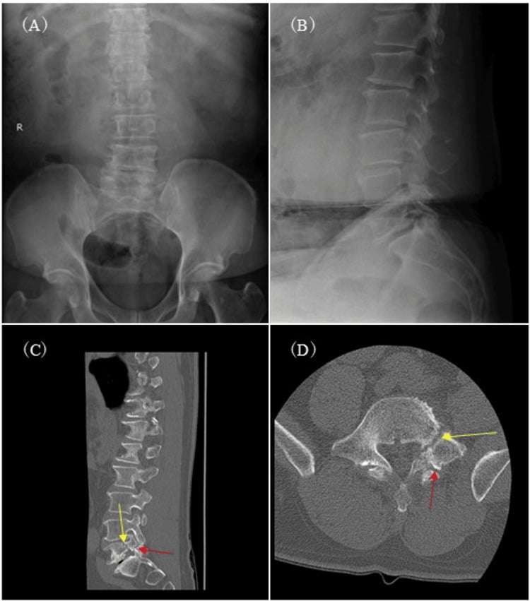 Preoperative radiographs and CT demonstrating L5 spondylolysis with a concurrent ipsilateral pedicle fracture