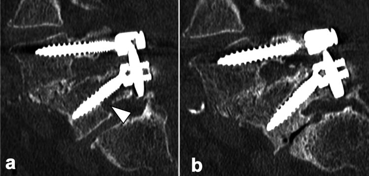 Sagittal CT thirty-six days after surgery showing bilateral L5 pedicle fractures with the eighteen-month follow-up appearance