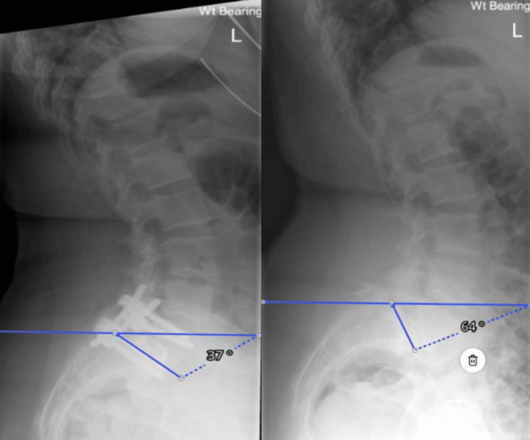 Standing lateral radiographs showing measurement of the sacral slope between the sacral endplate and horizontal