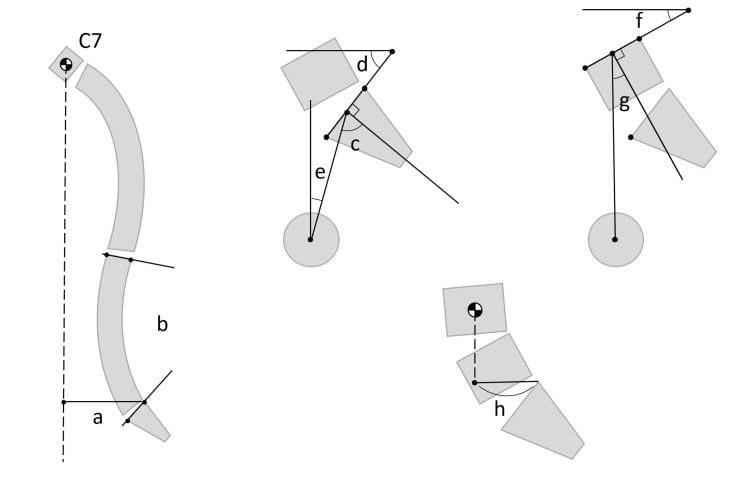 Diagram defining sagittal vertical axis from the C7 plumb line, lumbar lordosis, pelvic incidence, pelvic tilt and sacral slope