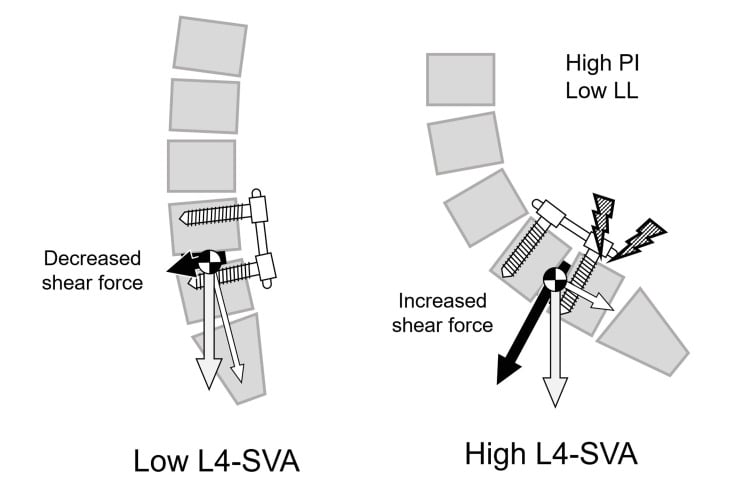 Diagram contrasting decreased shear force with a low L4 sagittal vertical axis against increased shear force in a high pelvic incidence, low lumbar lordosis configuration