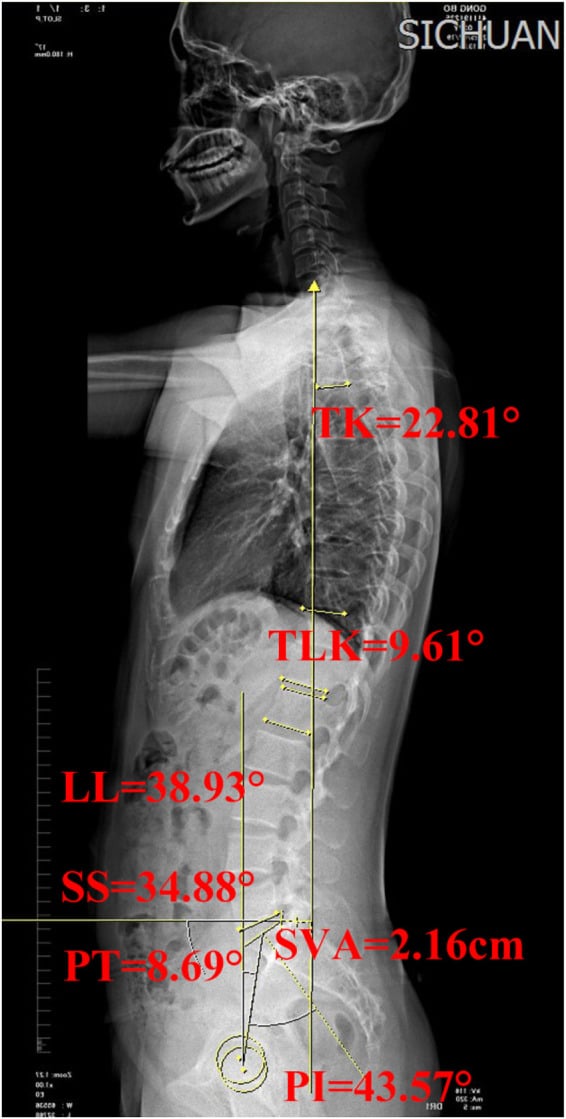Full-length standing radiograph annotated with thoracic kyphosis, lumbar lordosis, sacral slope, pelvic tilt, pelvic incidence and sagittal vertical axis values