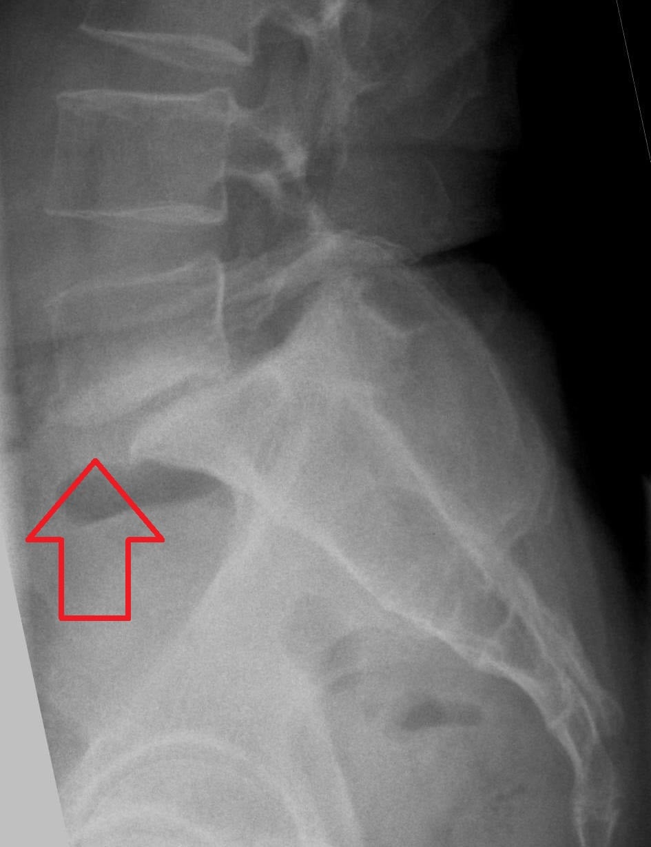 Lateral lumbar radiograph showing anterolisthesis of L5 on S1, with the slip marked by an arrow.