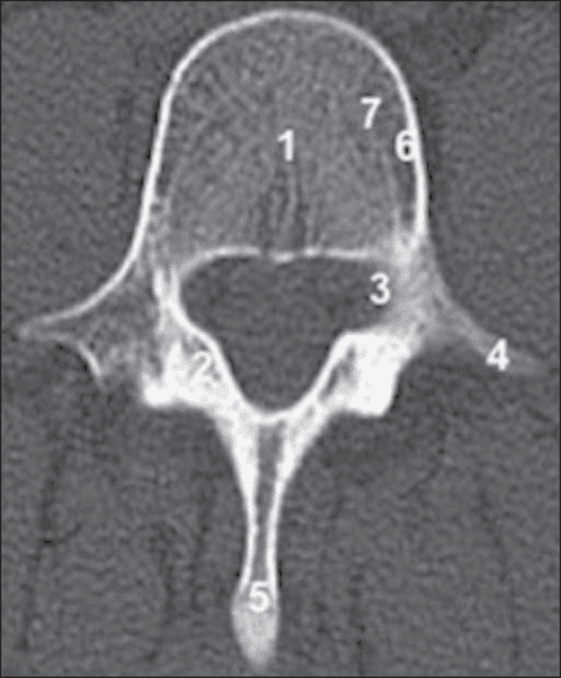Cross-sectional CT of a lumbar vertebra with numbered labels on body, lamina, pedicles, transverse and spinous processes.