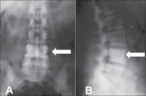 Frontal and lateral lumbar spine X-rays with arrows marking a densely white L4 vertebral body.