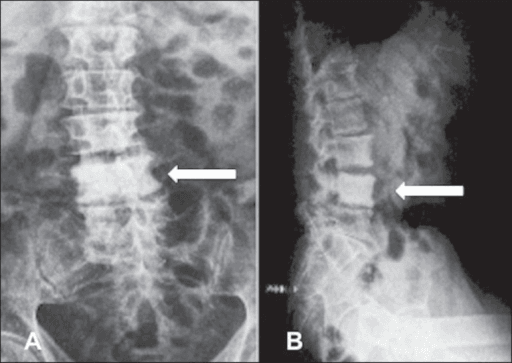 Frontal and lateral lumbar X-rays showing a dense L4 vertebral body with an arrow indicating left-sided erosion.
