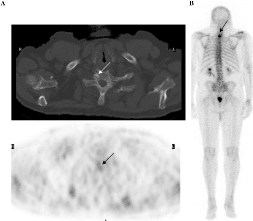 Axial PET-CT fused image through the upper chest.