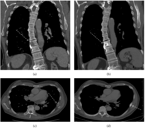 Four imaging panels comparing lytic T10 vertebral and rib lesions before therapy with sclerotic appearances after therapy.