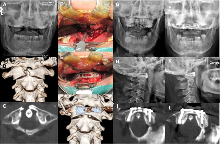 Clinical imaging and operative sequence of a displaced anterior and posterior C1 arch fracture treated by transoral anterior ring osteosynthesis