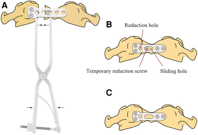 Three-panel schematic showing temporary screw placement, compression reduction and definitive anterior C1 ring plate fixation