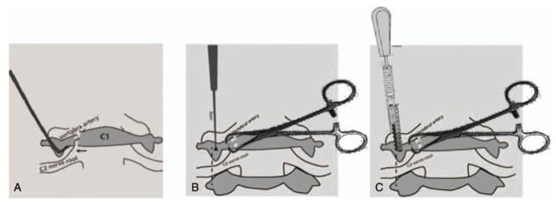 Three-panel illustration showing palpation of the medial C1 pedicle boundary, lateral-mass control with a clamp and insertion of a C1 screw