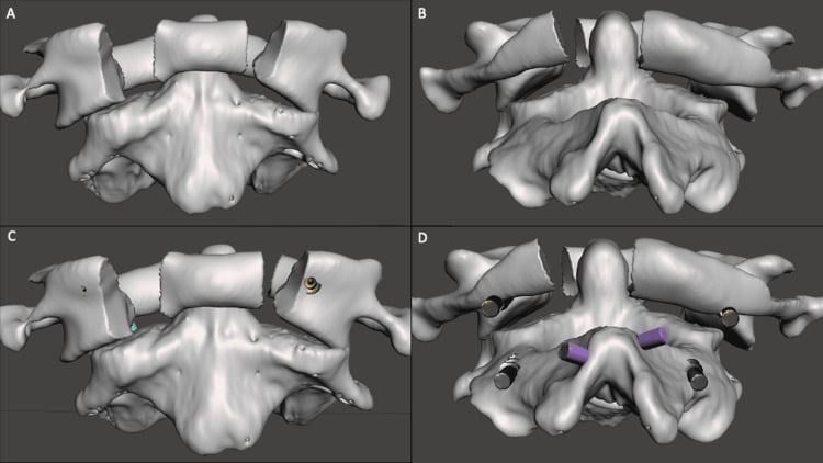 Three-dimensional simulation of a displaced C1 ring fracture before and after C1 lateral-mass, C2 pedicle and C2 laminar screw placement