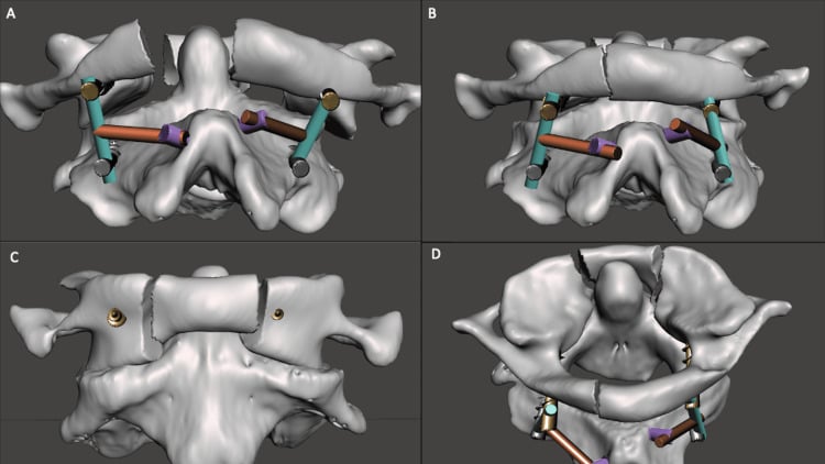 Four-panel three-dimensional sequence showing progressive reduction of displaced C1 lateral masses through a C1-C2 screw-rod construct