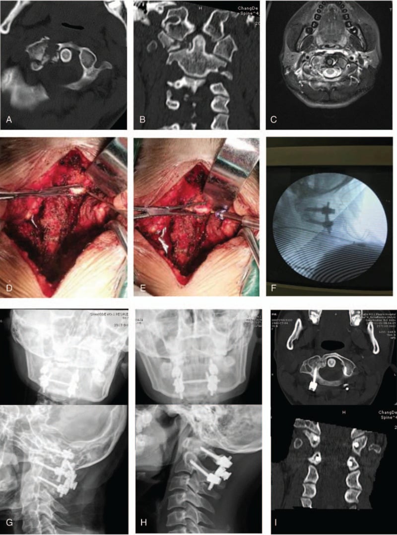 Multimodal imaging and operative sequence for a Gehweiler type III atlas fracture, including three-dimensional CT, axial MRI, intraoperative fixation and postoperative radiographs