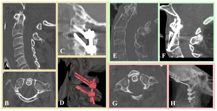 Preoperative CT and postoperative imaging examples of Harms C1-C2 fixation and occipitocervical fixation for upper cervical fractures