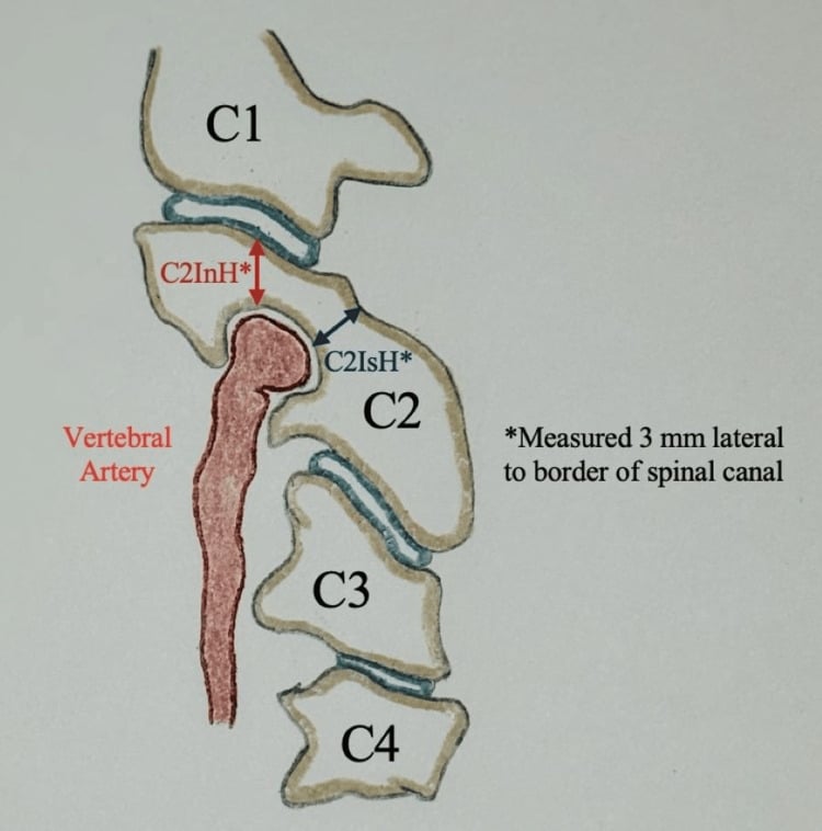 Sagittal schematic of C2 showing vertebral artery position and the C2 isthmus-height and internal-height measurements used to identify a high-riding artery