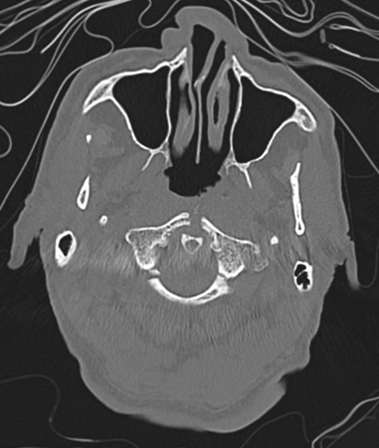 Axial CT scan showing Jefferson fracture with fractures of both anterior and posterior arches of the atlas (C1)