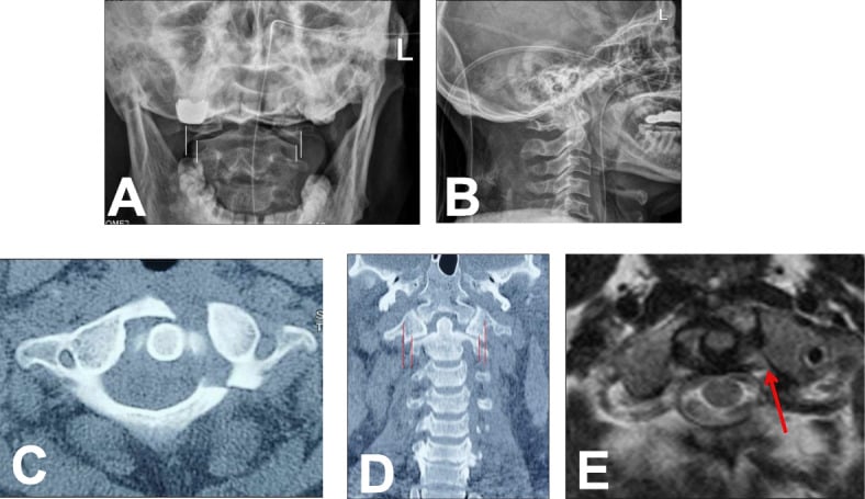 Coronal CT and open-mouth radiograph showing lateral mass displacement measurement in Jefferson fracture
