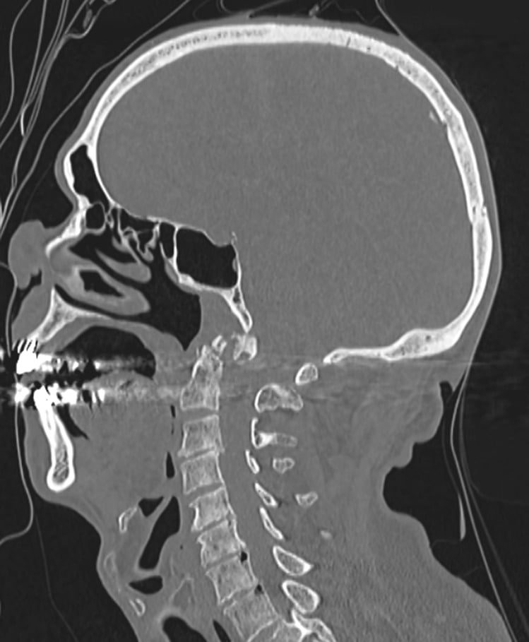 Sagittal CT showing Jefferson fracture with associated odontoid (dens) fracture and posterior skull displacement