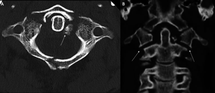 Axial CT of a displaced C1 ring fracture with transverse-ligament tubercle avulsion and coronal CT measurement of combined lateral-mass displacement