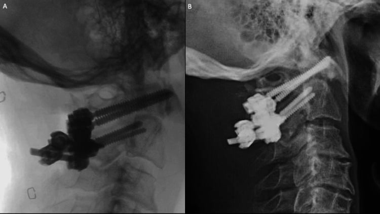 Intraoperative and eight-week postoperative cervical radiographs showing maintained C1-C2 fixation and atlantodental alignment