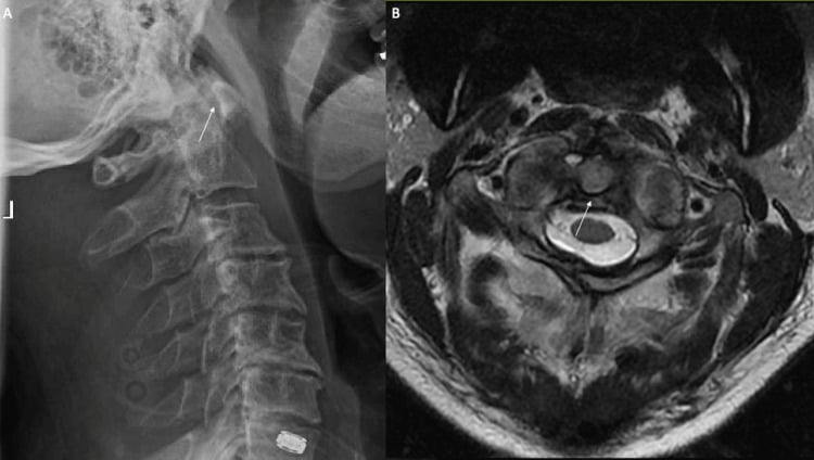 Lateral cervical radiograph showing an increased atlantodental interval and axial T2 MRI showing transverse atlantal ligament disruption