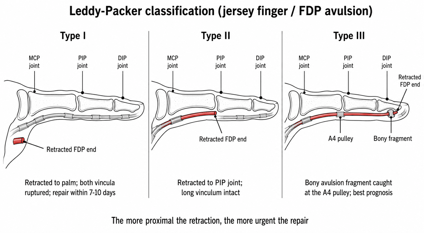 Three-panel finger diagram of the Leddy-Packer classification of FDP avulsion: Type I retracted to palm, Type II to PIP joint, Type III bony fragment at the A4 pulley