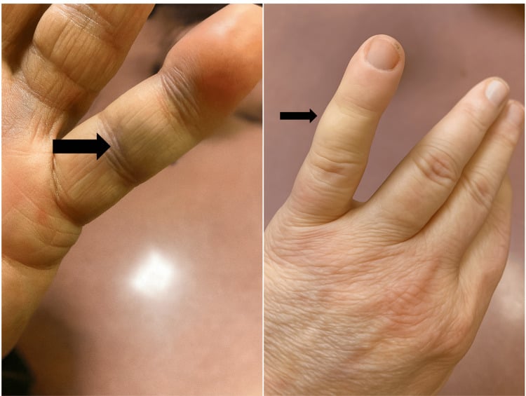 Volar and dorsal clinical photographs of a little finger with focal bruising and swelling after FDP bony avulsion.