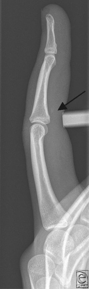 Lateral finger radiograph showing a small FDP avulsion fragment retracted proximally to the PIP joint.