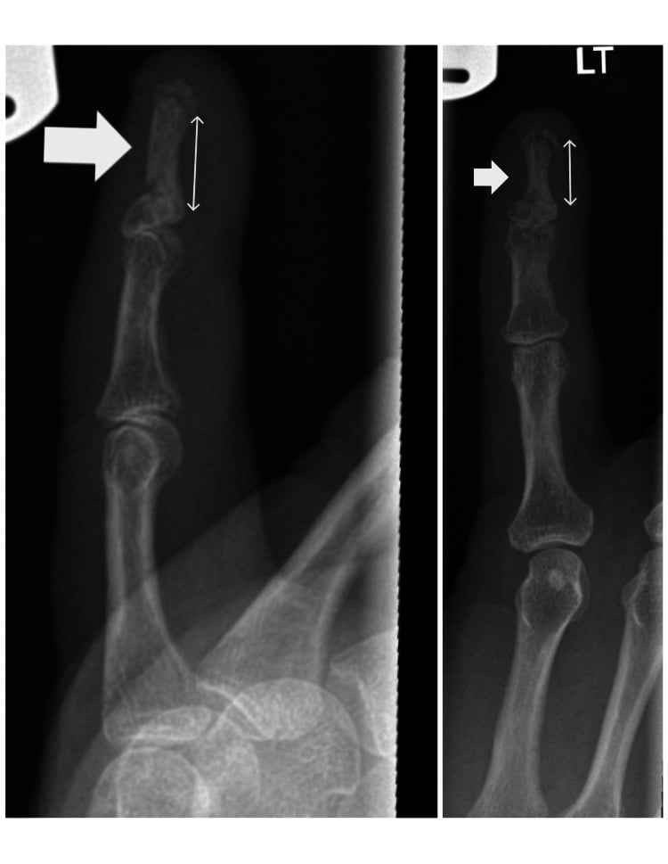 Six-week AP and lateral radiographs showing union of a distal-phalanx FDP bony avulsion after K-wire fixation.