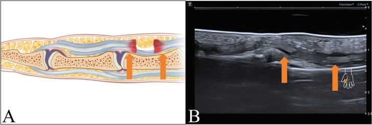 Long-axis schematic and ultrasound showing discontinuity of a flexor tendon with separated tendon ends marked by arrows.