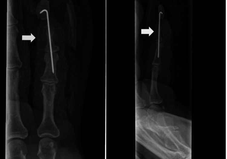 Immediate postoperative AP and lateral radiographs showing reduction of a large distal-phalanx FDP avulsion fragment with Kirschner-wire fixation.