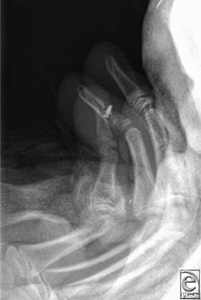 Lateral postoperative finger radiograph showing a bone anchor securing an avulsed FDP tendon to the distal phalanx.