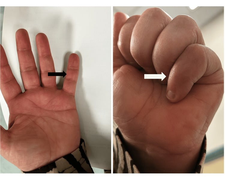 Three-month clinical photographs showing a healed volar scar and active flexion after repair of a bony FDP avulsion.