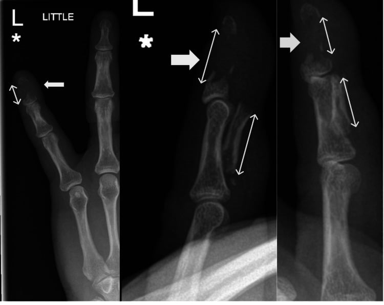 AP, oblique and lateral radiographs showing a large extra-articular bony avulsion fragment from the distal phalanx.