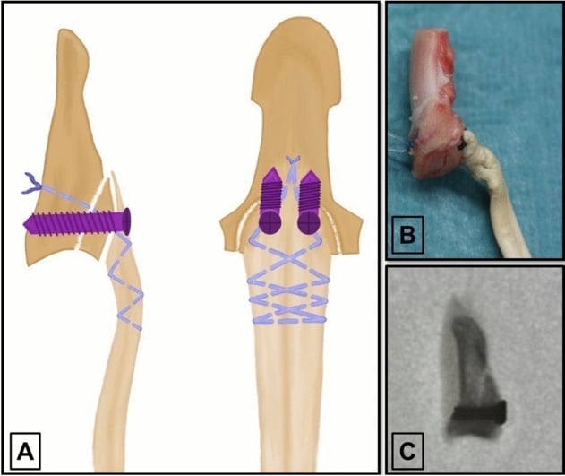 Schematic, specimen and fluoroscopic views of Type IV jersey finger repair using minifragment screws and an interosseous tendon suture.