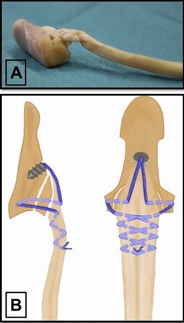 Cadaveric specimen and schematic showing Type IV jersey finger repair with a suture anchor securing the bony and tendinous components.