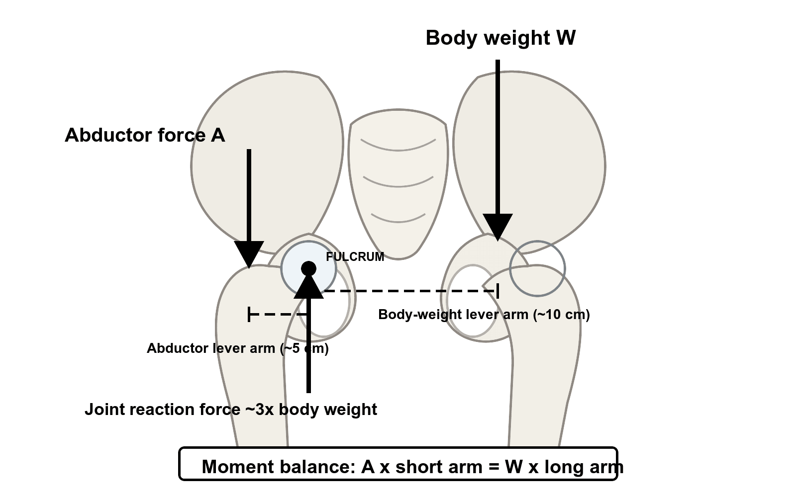 Free-body diagram of the hip in single-leg stance showing body weight, abductor force, joint reaction force and their lever arms about the femoral head fulcrum