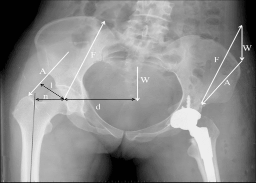 AP pelvis radiograph with body-weight, abductor and hip-joint reaction force vectors