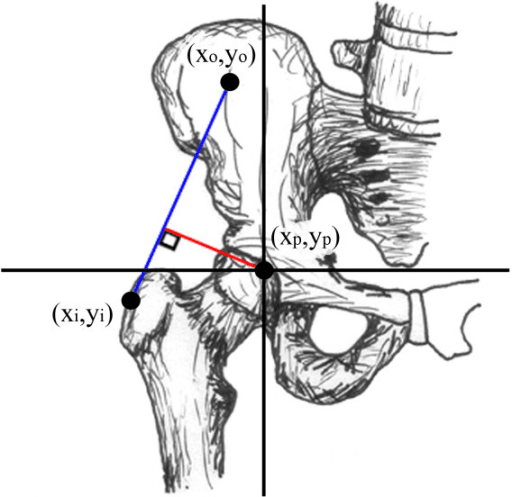 Coronal hip diagram showing the perpendicular hip abductor moment arm