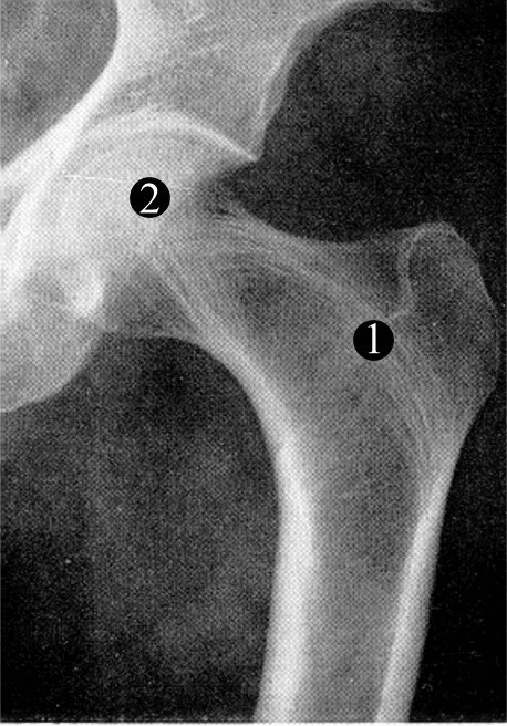 Proximal femur radiograph showing principal trabecular groups