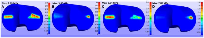 Tibial insert contact pressure distribution during different gait patterns