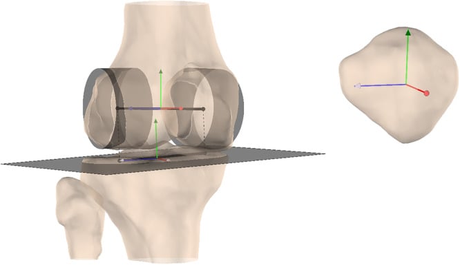 Three-dimensional knee coordinate systems used to quantify medial and lateral femoral condylar motion