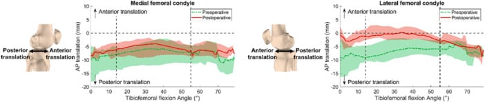 Graphs comparing medial and lateral femoral condylar translation before and after total knee arthroplasty