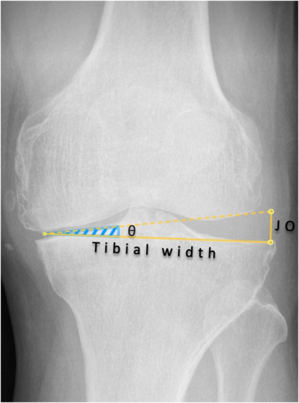 Schematic relating coronal angular knee laxity to medial or lateral tibiofemoral joint opening